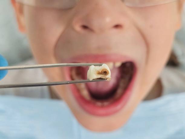 Best Emergency Treatment for Toothache in Kiln, MS